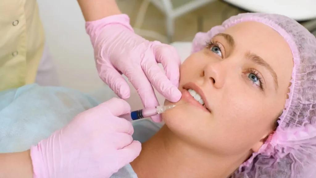 Dermal fillers lip enhancement — non-surgical cosmetic treatment using hyaluronic acid for natural volume