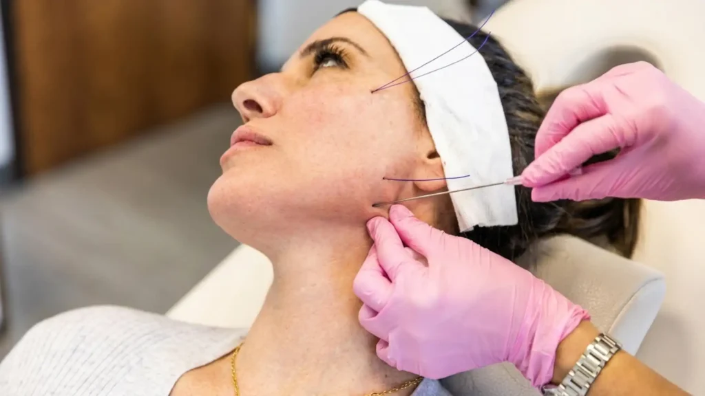 Thread lift procedure — non-surgical facelift technique to lift and tighten jawline and facial skin
