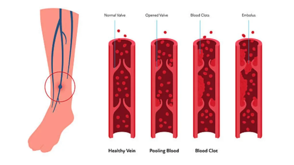 Flying after cosmetic surgery showing cosmetic surgery DVT risk and blood clot dangers
