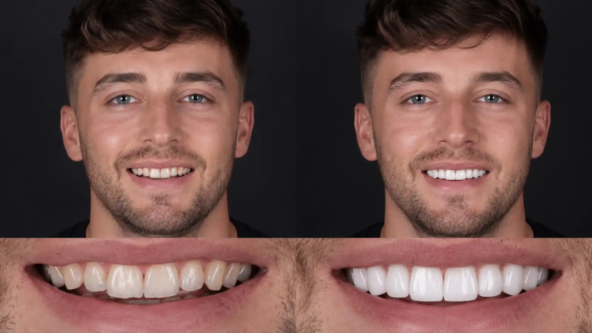 Turkey teeth cosmetic dental treatment abroad before and after results